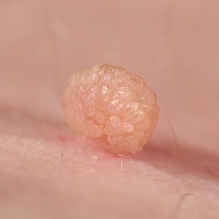 Papilloma.