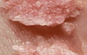 Acute condylomas.